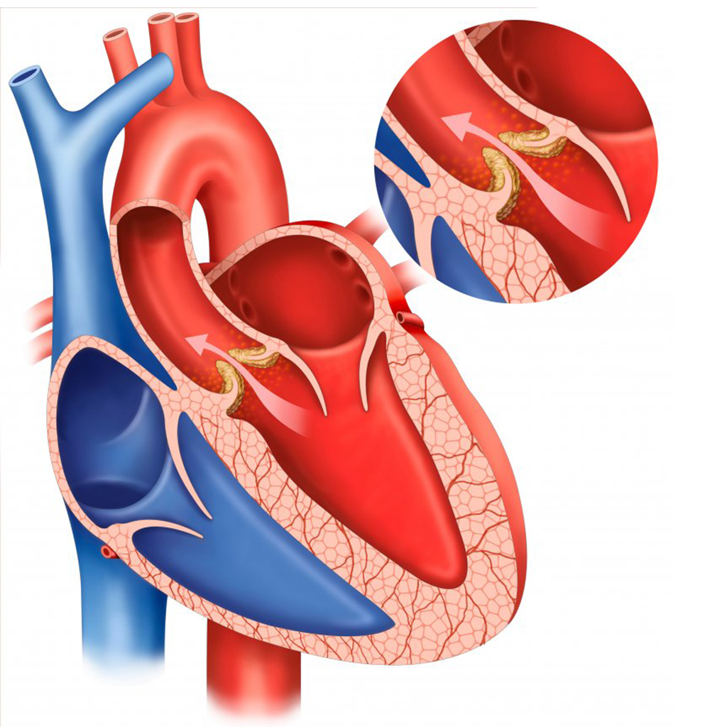 Пороки клапанов сердца - симптомы, типы, лечение, причины